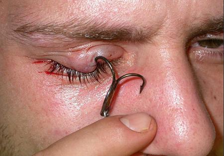 Click image for larger version. 

Name:	fishhok injury to the eyelid of right eye.jpg 
Views:	2 
Size:	75.8 KB 
ID:	17615
